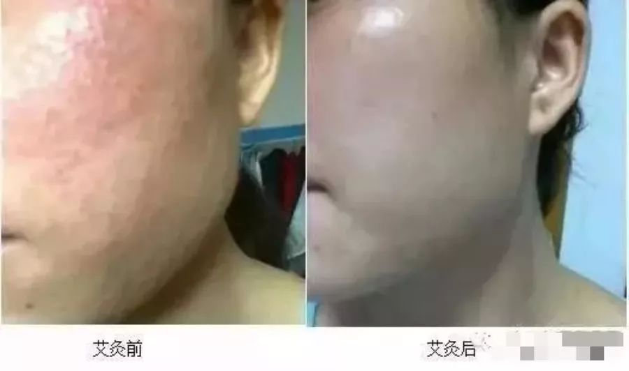 艾灸美容