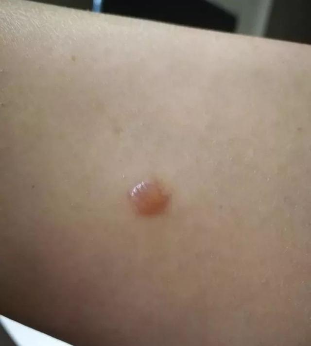 艾灸低温烫伤