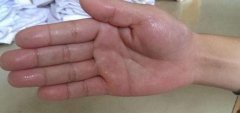 艾灸治好我的多汗症