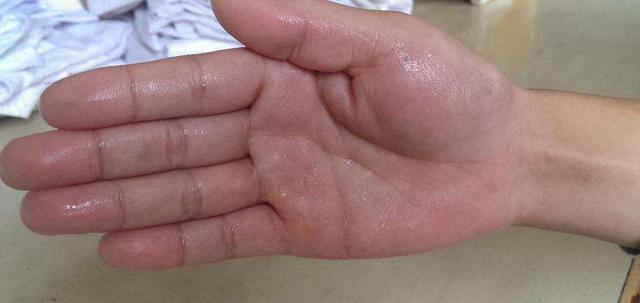 多汗症怎么治疗