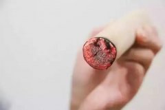 艾灸的好处:春天为什么适合艾灸?