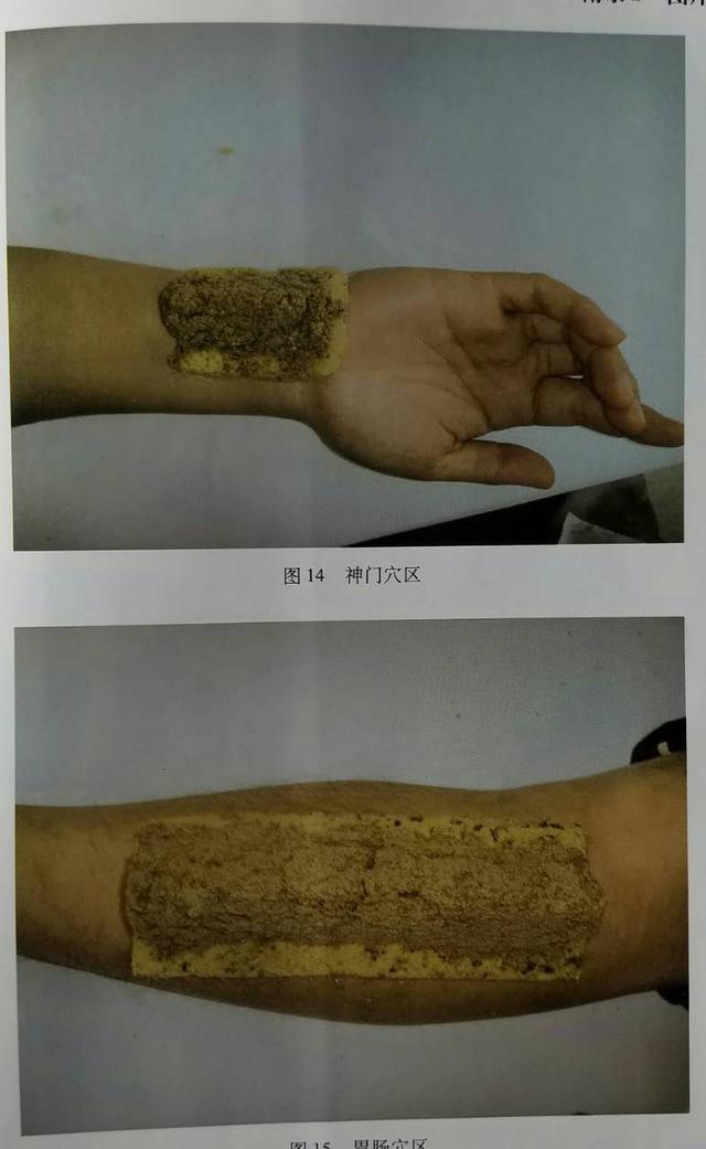 艾灸的作用