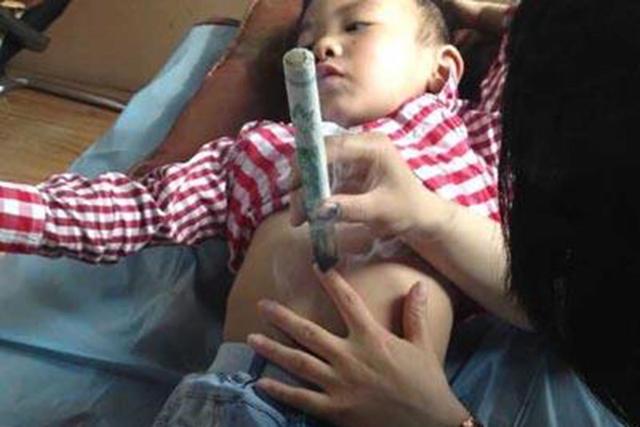 小儿艾灸