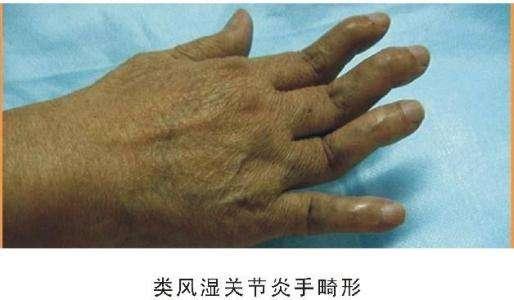 类风湿艾灸效果好不好?艾灸哪个穴位?