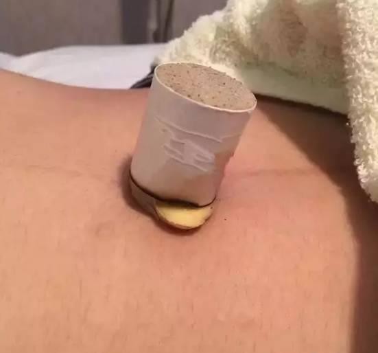 艾灸的禁忌