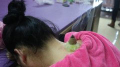 艾灸后注意事项