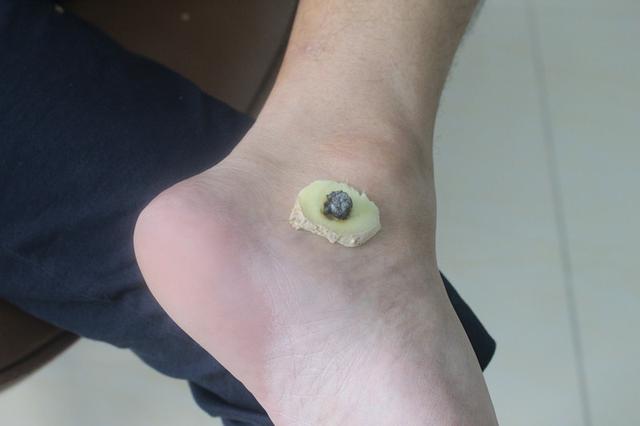 艾灸的禁忌:晚上可以艾灸吗?