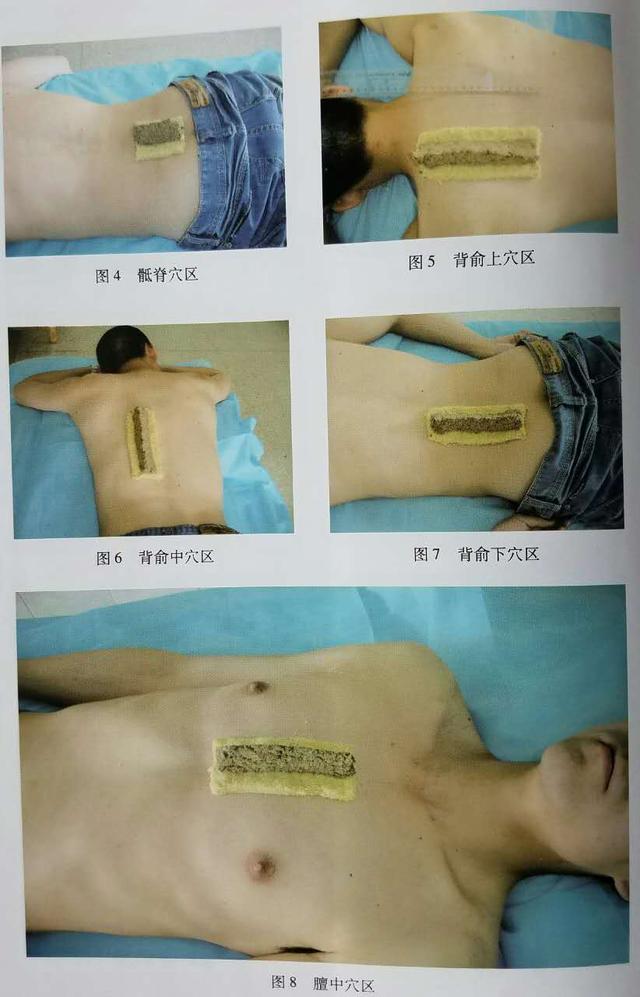 铺灸怎么做