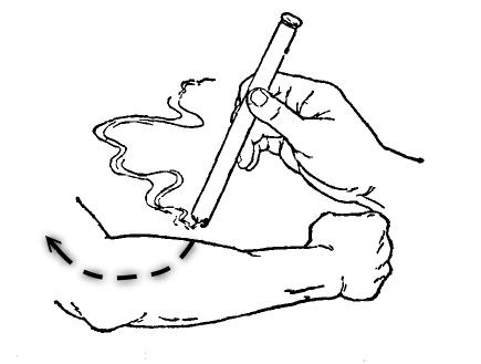 雀啄灸的方法