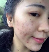 痘痘怎么消除艾灸哪些穴位?艾灸治痘痘作用好吗