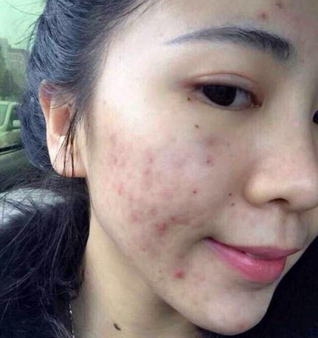 痘痘怎么消除