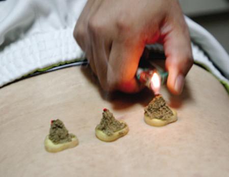 艾灸养生的好处