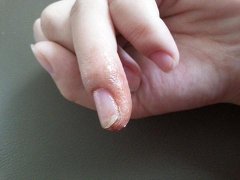 湿气重怎么调理艾灸什么穴位?艾灸除湿有作用吗