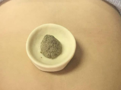 艾灸肚脐的作用