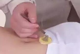 艾灸补益的基本方法及手法