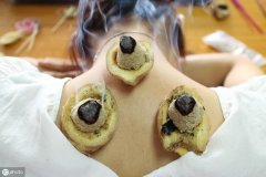 什么是艾灸?艾灸几壮是什么意思?