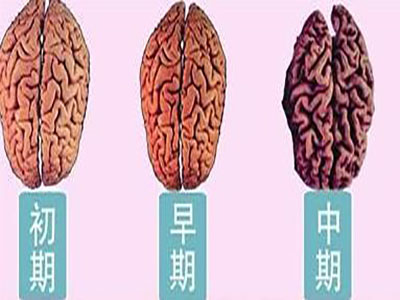 脑萎缩