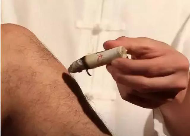 艾灸疗法