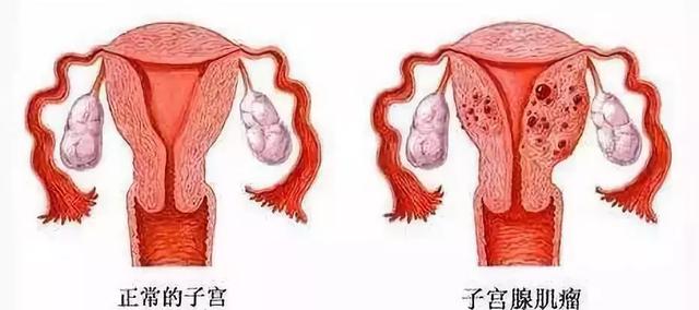 子宫肌瘤