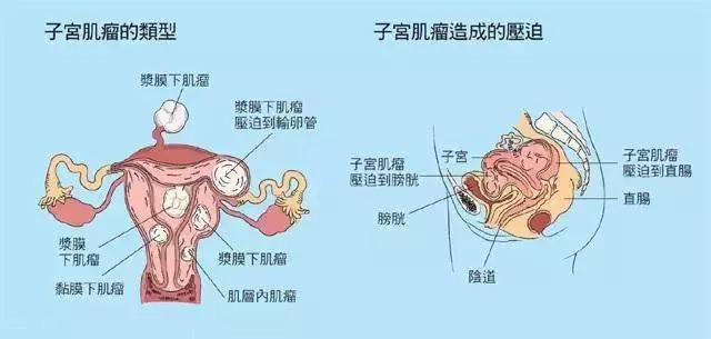子宫肌瘤症状