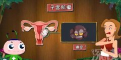 子宫肌瘤症状,艾灸是调理肌瘤较佳选择!