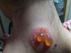 艾灸持久才有效秘诀都藏在这里了!