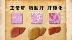 这几个穴才是艾灸养肝最重要的穴