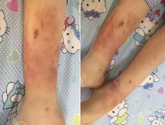 第三章常见病灸疗法与配穴:外科及皮肤科疾病