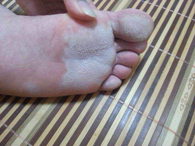 艾灸治脚气,真的管用吗?看完惊喜