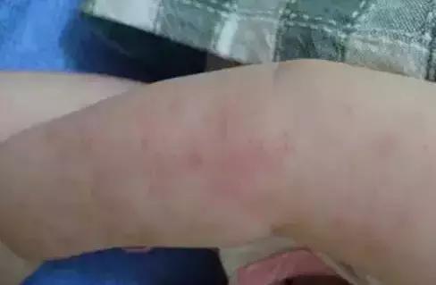皮肤骚痒