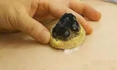 肺炎