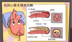 冠心病的预防和艾灸调理