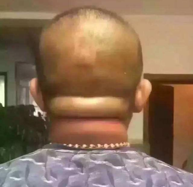 脖子上堆肉