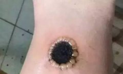直接灸痛苦但有效!解决痛风就靠艾灸!