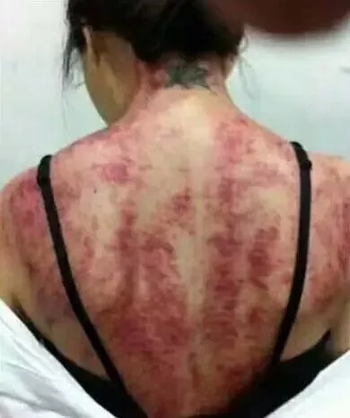 女性寒湿重,祛寒湿最快速的方法—艾灸!