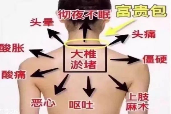 艾灸消除富贵包