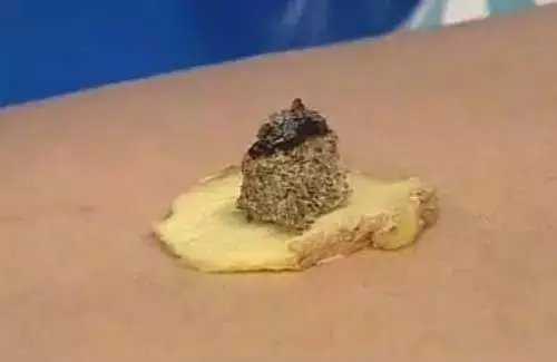 脐疗