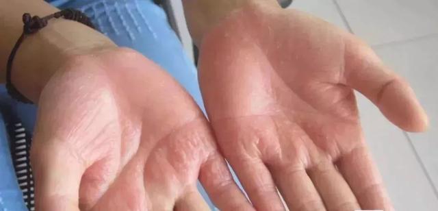 夏天手上就长小水疱?汗疱疹别挑破艾灸止痒防复发