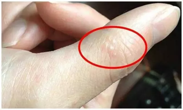 小水疱