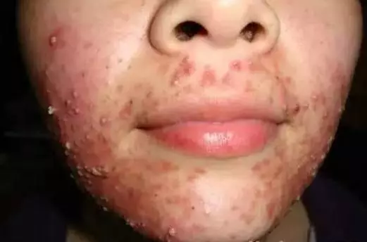 痤疮怎么办?艾灸这个穴位治好痤疮,有人试过靠谱!