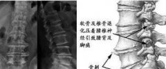 骨刺骨质增生骨质疏松怎么办?艾灸调理这样做