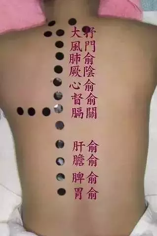 背部常艾灸