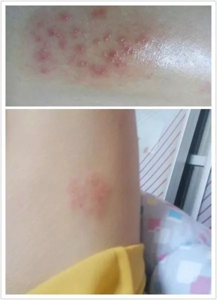 艾灸一下湿疹去无踪,大多数皮肤病都可这样灸!