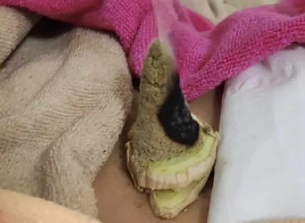 艾灸神阙