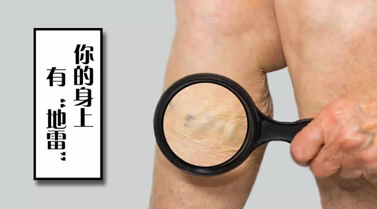 筋结不散危及五脏,拉筋+艾灸散结百病消!
