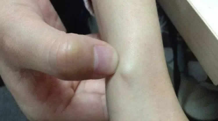 筋结不散危及五脏