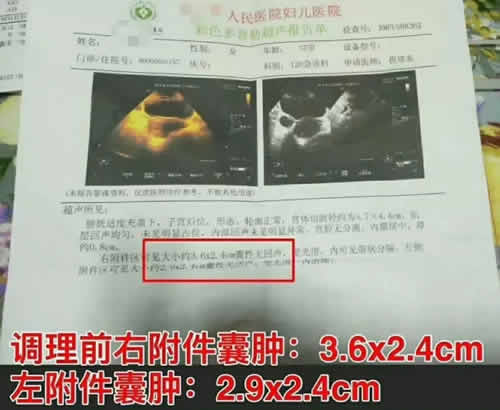 艾灸对附件囊肿确实有其效果