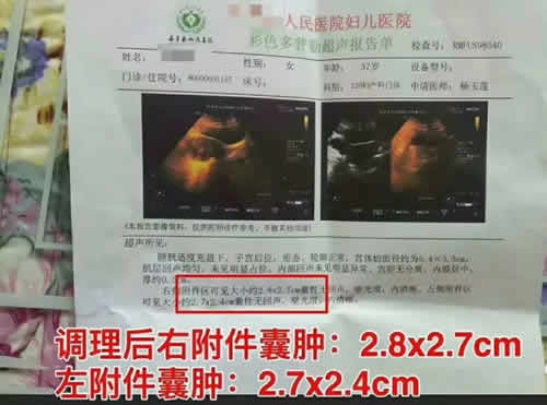 艾灸对附件囊肿确实有其效果