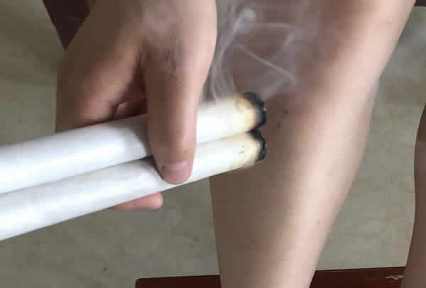 艾灸养生疗法