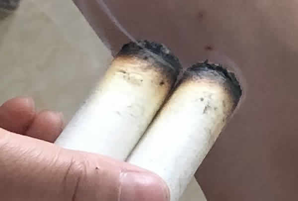 <b>膝关节骨性关节炎艾灸穴位</b>